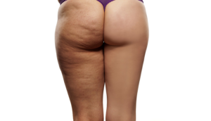 celulitis