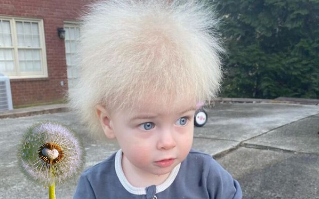 Niño con el síndrome del pelo indomable